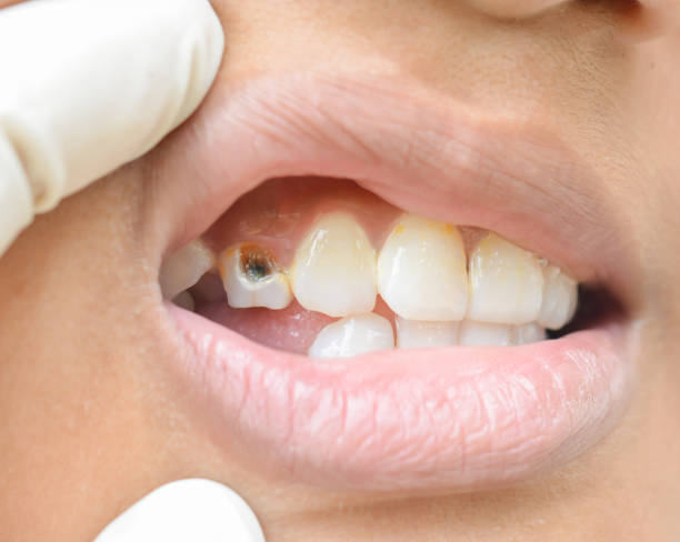 Caries