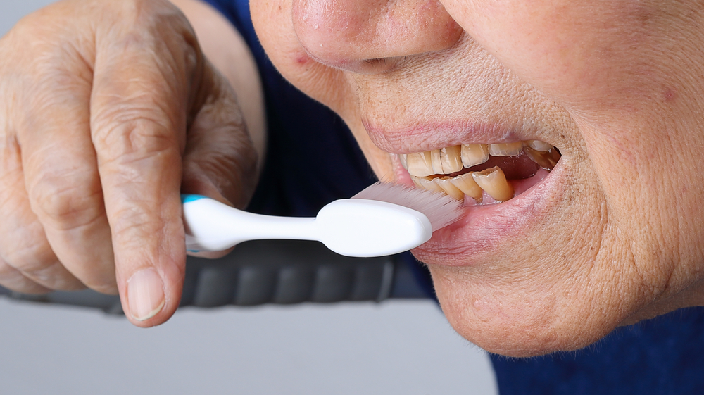 Erosión Dental