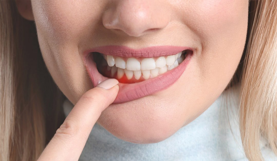 Gingivitis