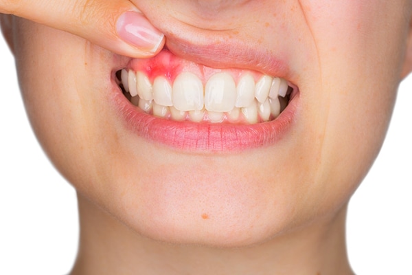 Periodontitis